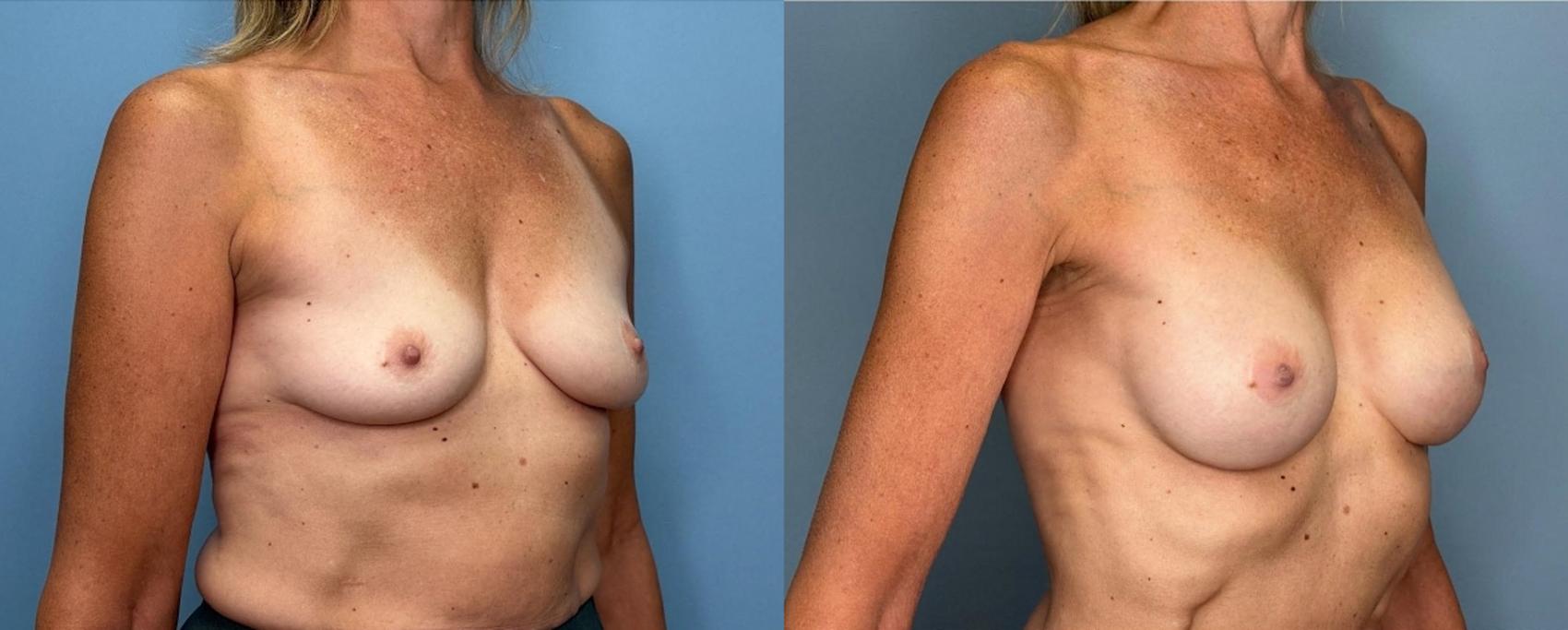 Before & After Breast Augmentation Case 438 Right Oblique View in Ann Arbor, MI
