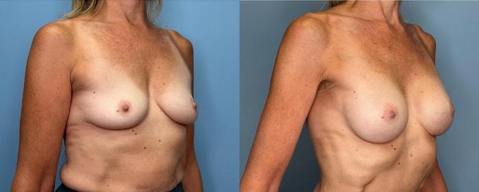Before & After Breast Augmentation Case 438 Right Oblique View in Ann Arbor, MI