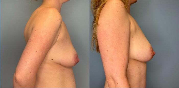 Before & After Breast Augmentation Case 447 Right Side View in Ann Arbor, MI