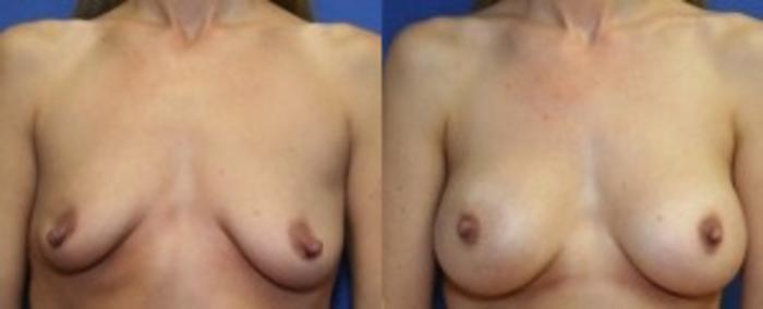 Before & After Breast Augmentation Case 6 Front View in Ypsilanti, MI