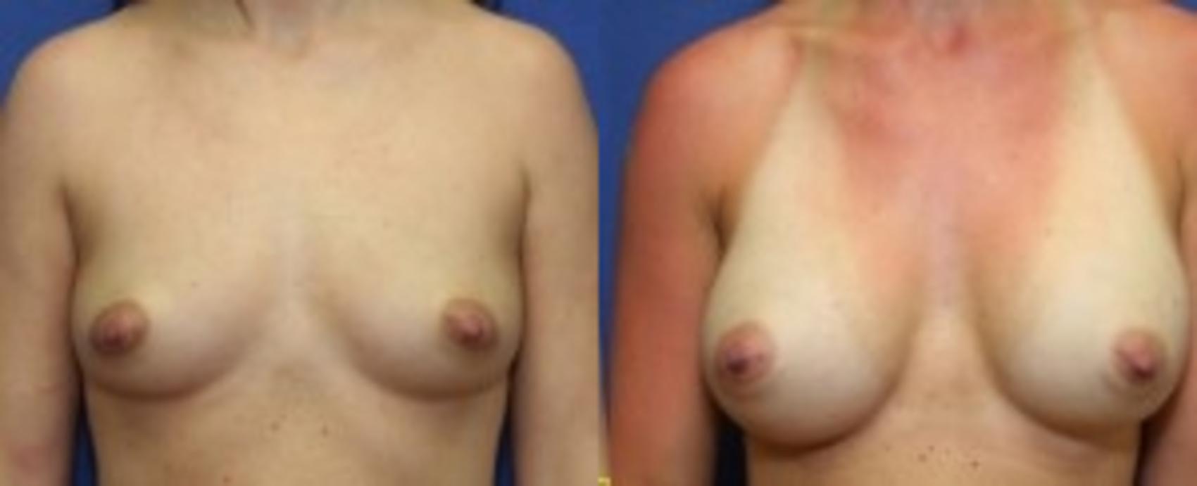 Before & After Breast Augmentation Case 7 Front View in Ann Arbor, MI