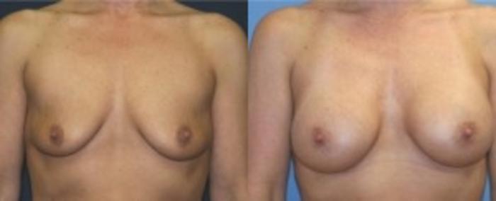 Before & After Breast Augmentation Case 8 Front View in Ypsilanti, MI