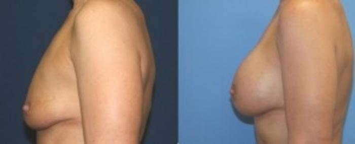 Before & After Breast Augmentation Case 8 Left Side View in Ann Arbor, MI