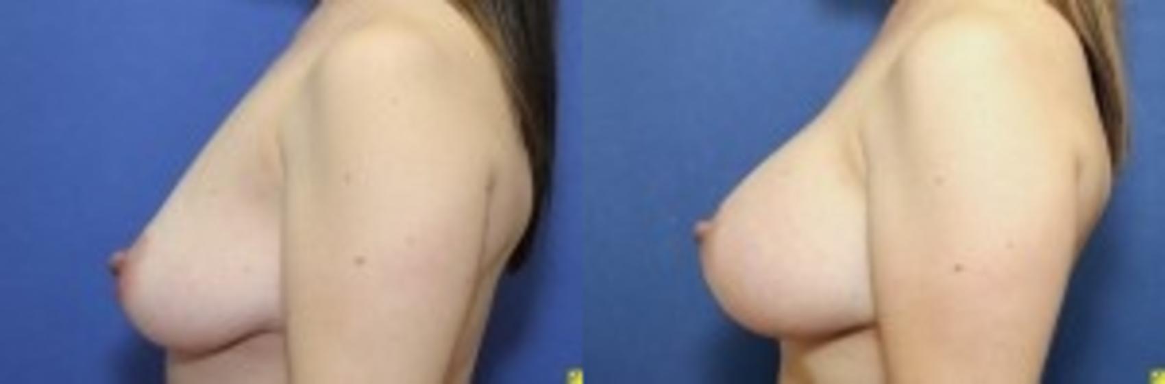 Before & After Breast Augmentation Case 88 Left Side View in Ann Arbor, MI