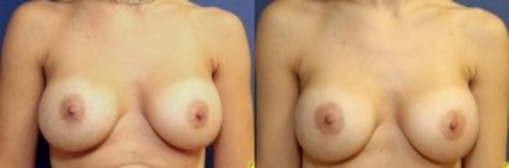 Before & After Breast Augmentation Case 89 Front View in Ann Arbor, MI