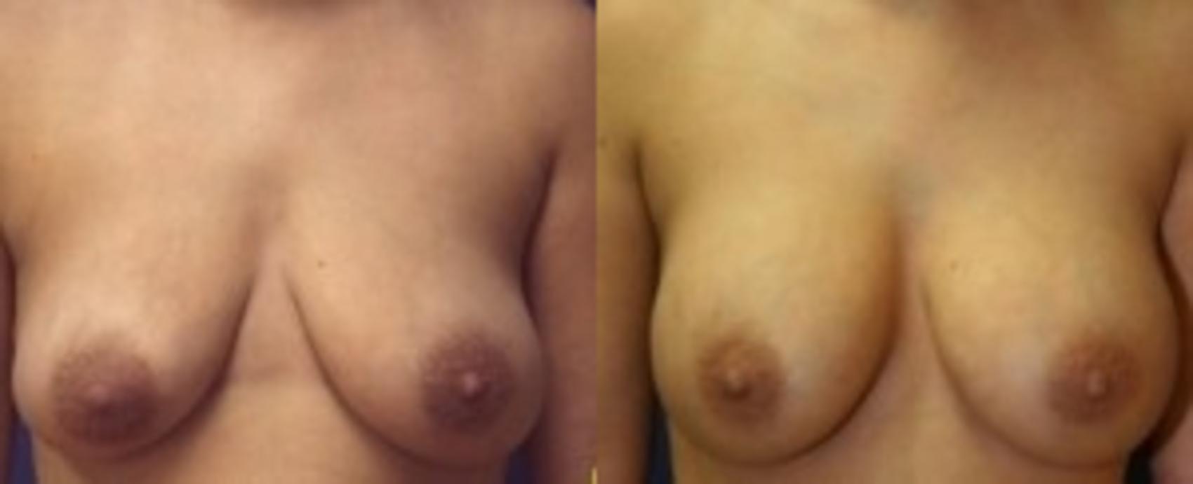 Before & After Breast Augmentation Case 9 Front View in Ann Arbor, MI