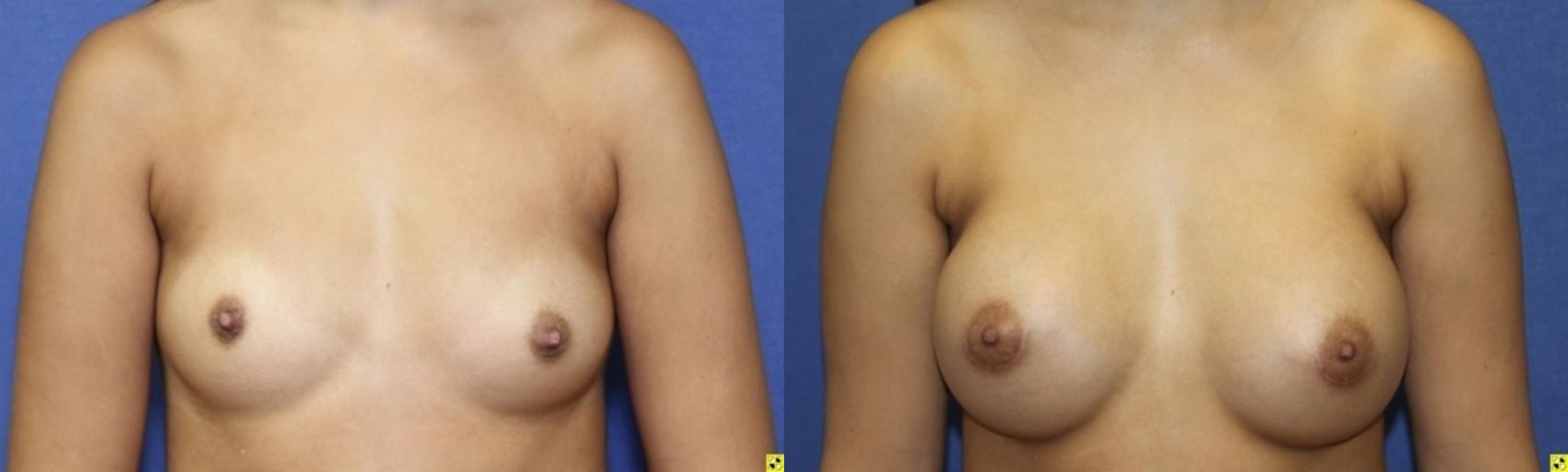 Before & After Breast Augmentation Case 90 Front View in Ann Arbor, MI