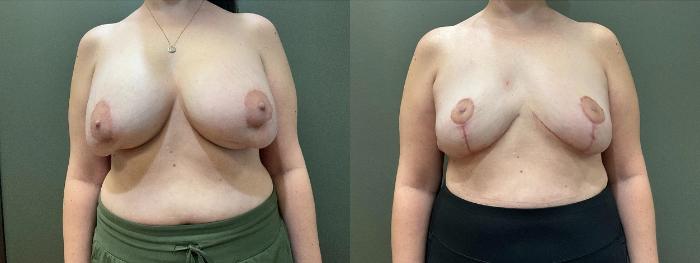 Before & After Breast Explant Case 421 Front View in Ann Arbor, MI
