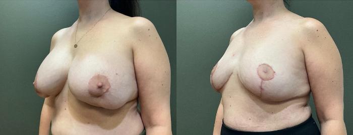 Before & After Breast Explant Case 421 Left Oblique View in Ann Arbor, MI