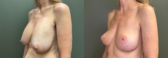 Before & After Breast Lift Case 424 Left Oblique View in Ann Arbor, MI