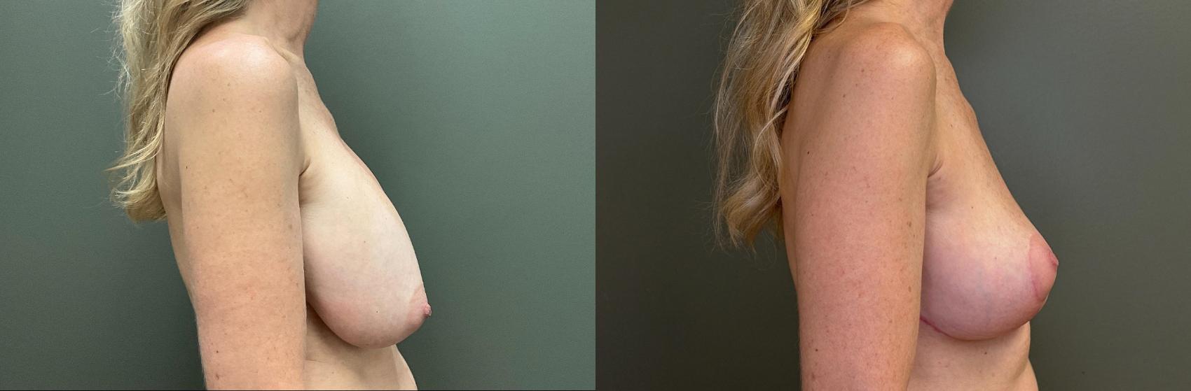 Before & After Breast Lift Case 424 Right Side View in Ann Arbor, MI