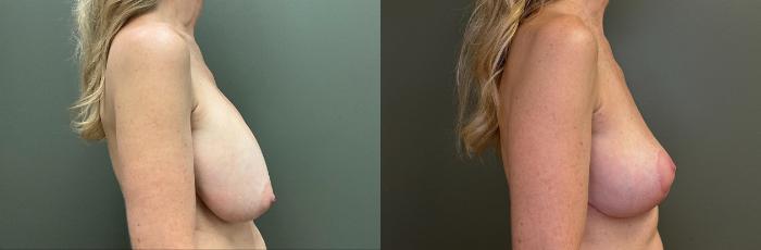 Before & After Breast Lift Case 424 Right Side View in Ann Arbor, MI