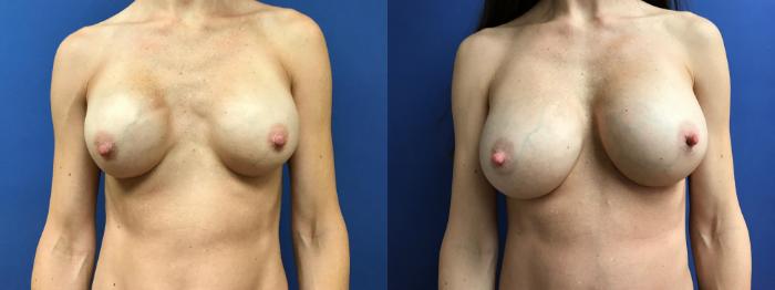 Before & After Breast Implant Revision Case 101 Front View in Ann Arbor, MI