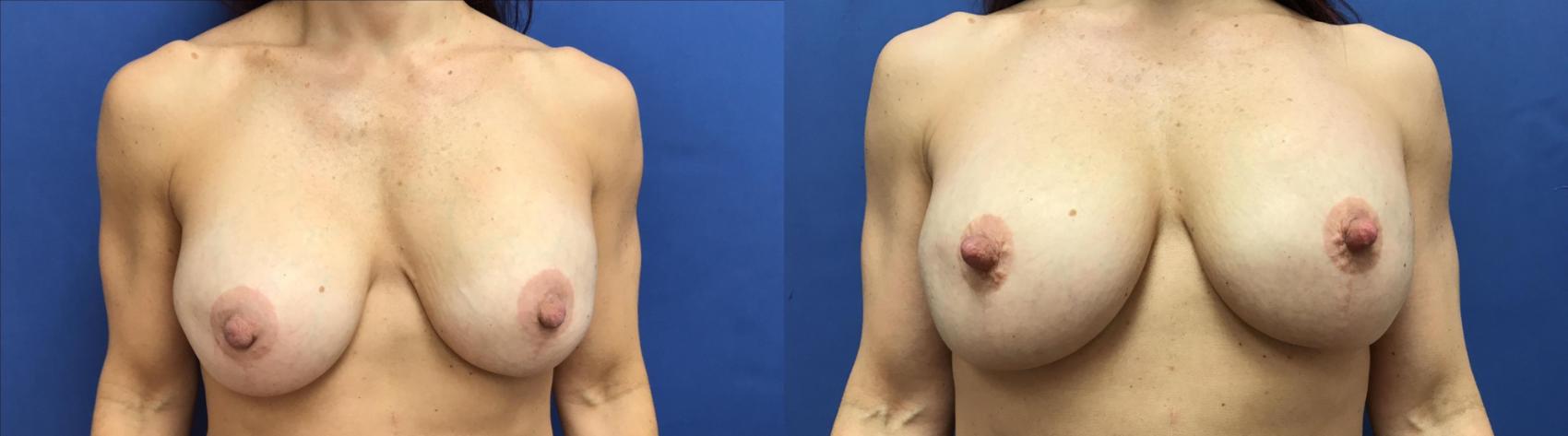 Before & After Breast Implant Revision Case 102 Front View in Ann Arbor, MI