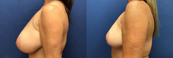 Before & After Breast Implant Revision Case 103 Left Side View in Ann Arbor, MI