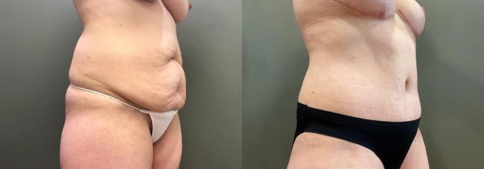 Before & After Liposuction Case 407 Right Oblique View in Ann Arbor, MI