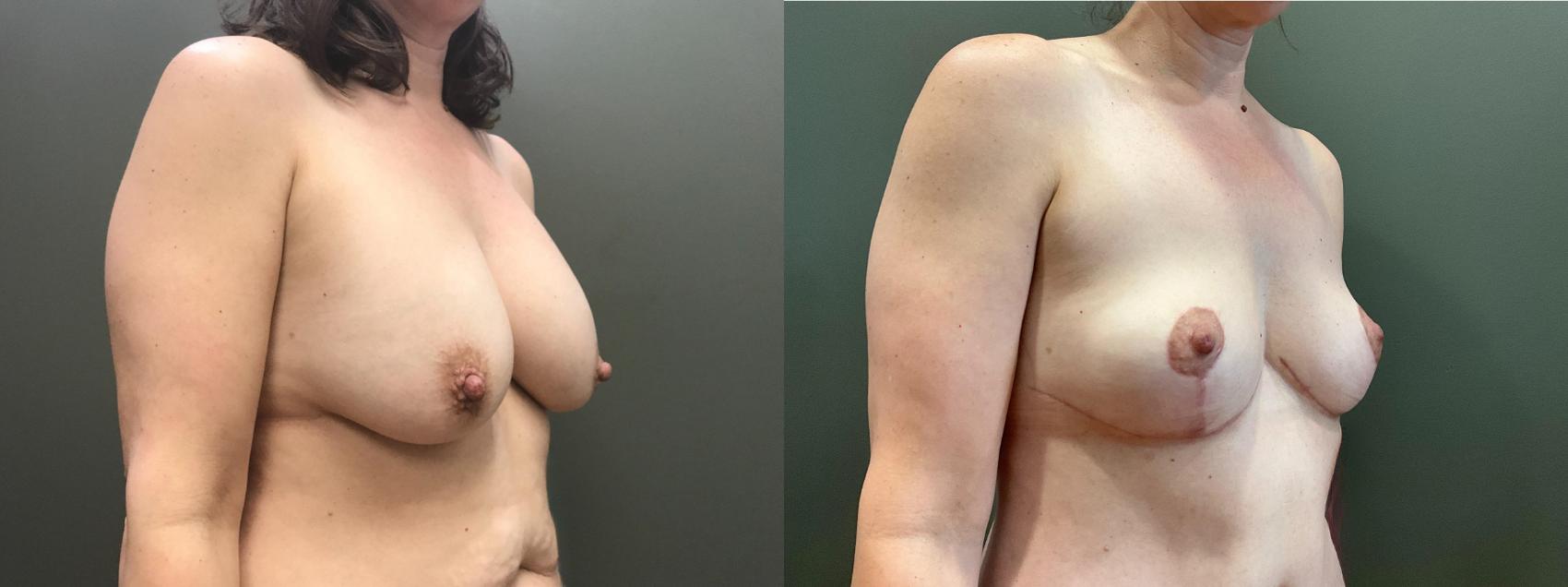 Before & After Breast Lift Case 407 Right Side View in Ann Arbor, MI