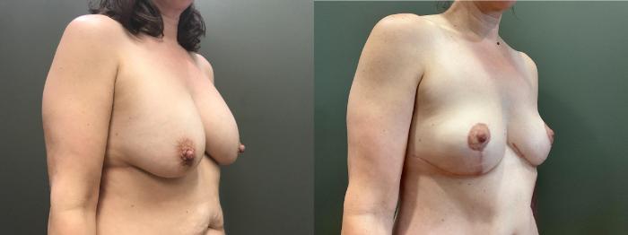 Before & After Liposuction Case 407 Right Side View in Ann Arbor, MI