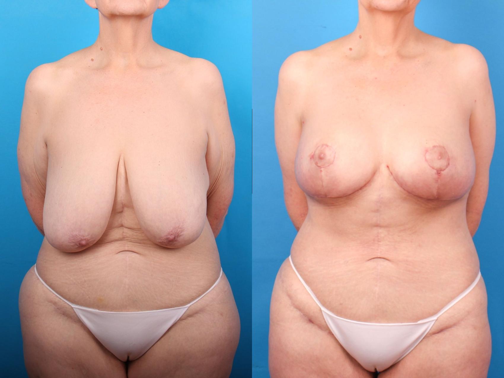 Before & After Breast Lift Case 409 Front View in Ann Arbor, MI