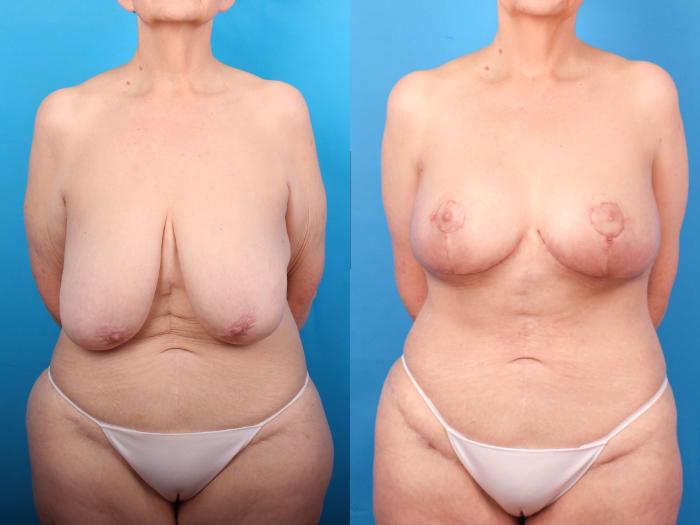 Before & After Breast Lift Case 409 Front View in Ann Arbor, MI