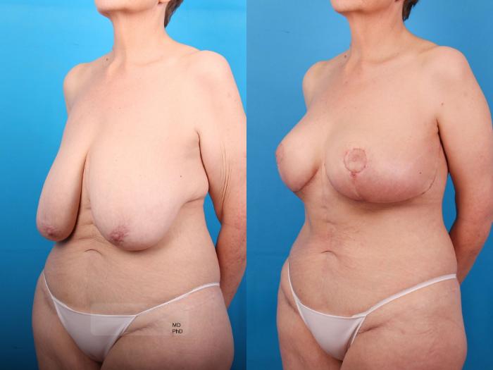 Before & After Breast Lift Case 409 Left Oblique View in Ann Arbor, MI