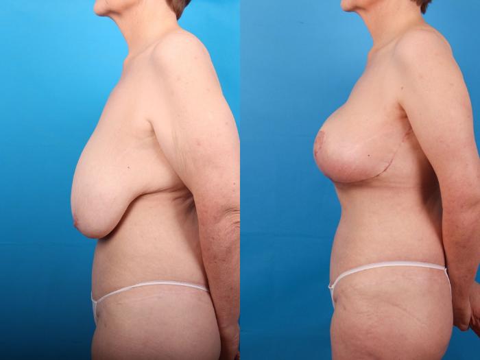 Before & After Breast Lift Case 409 Left Side View in Ann Arbor, MI