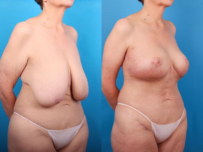 Before & After Breast Lift Case 409 Right Oblique View in Ann Arbor, MI