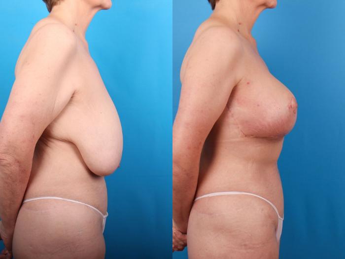 Before & After Breast Lift Case 409 Right Side View in Ann Arbor, MI