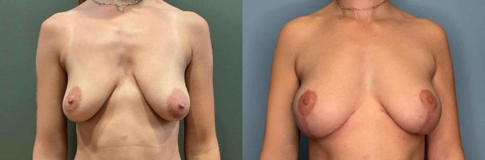 Before & After Breast Lift Case 432 Front View in Ann Arbor, MI