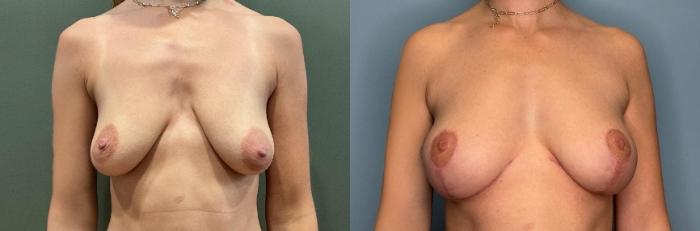 Before & After Breast Lift Case 432 Front View in Ann Arbor, MI