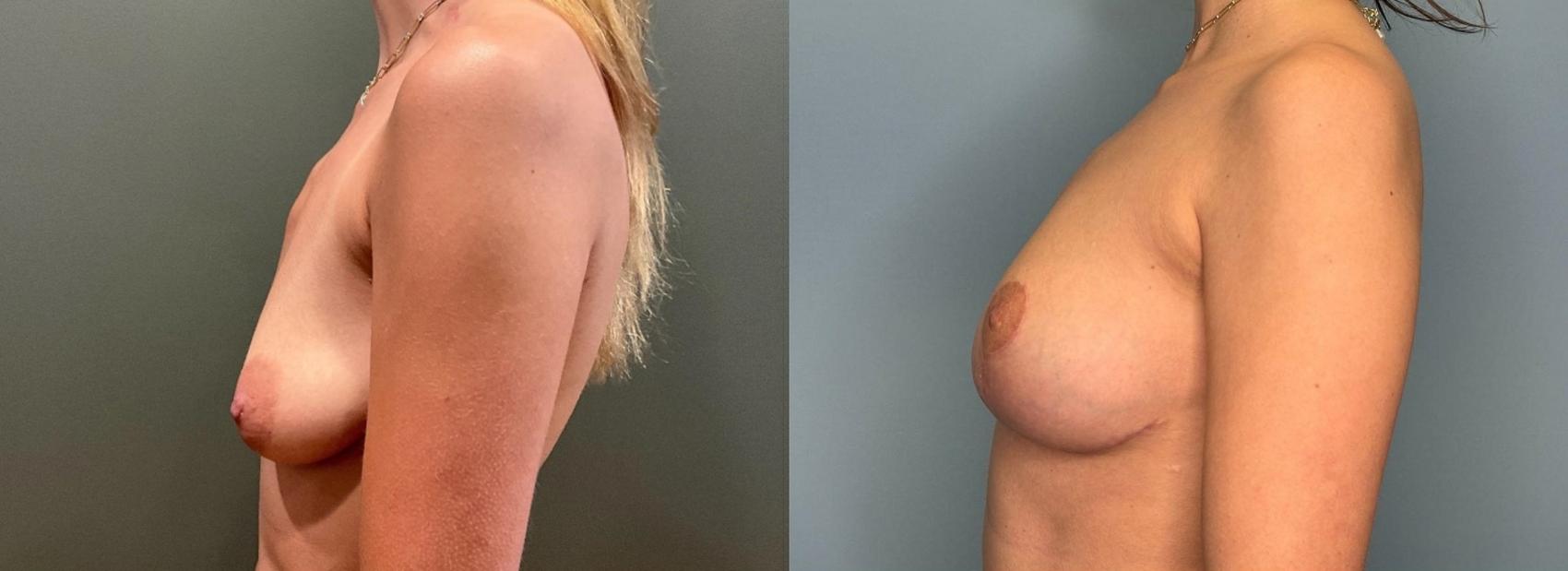 Before & After Breast Lift Case 432 Left Side View in Ann Arbor, MI