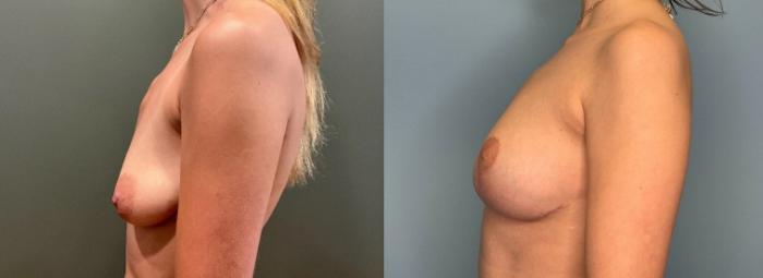 Before & After Breast Lift Case 432 Left Side View in Ann Arbor, MI