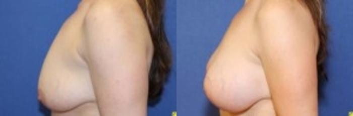 Before & After Breast Lift Case 91 Left Side View in Ann Arbor, MI