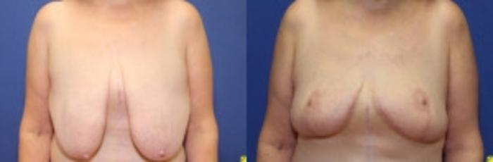 Before & After Breast Lift Case 92 Front View in Ypsilanti, MI