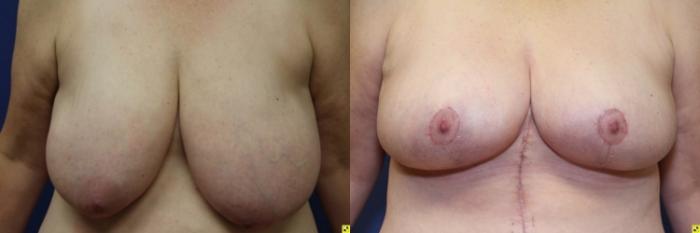 Before & After Breast Lift Case 93 Front View in Ypsilanti, MI
