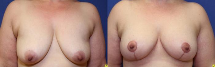 Before & After Breast Lift Case 94 Front View in Ypsilanti, MI