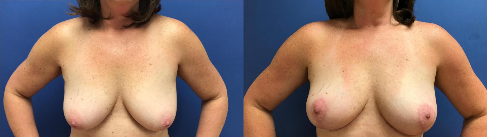 Before & After Breast Lift Case 95 Front View in Ann Arbor, MI