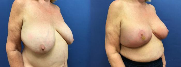 Before & After Breast Lift Case 96 Right Oblique View in Ypsilanti, MI