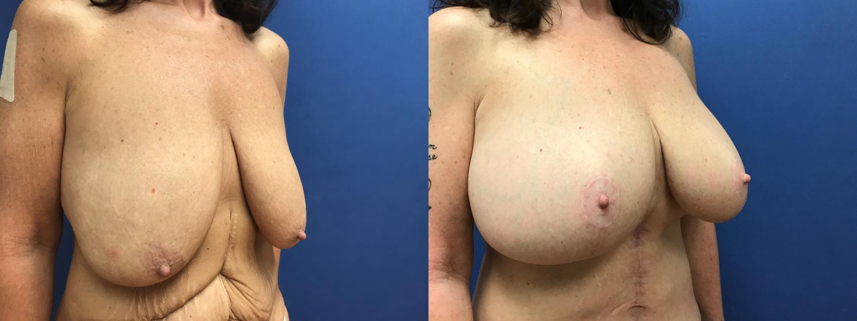 Before & After Breast Lift Case 97 Right Oblique View in Ypsilanti, MI
