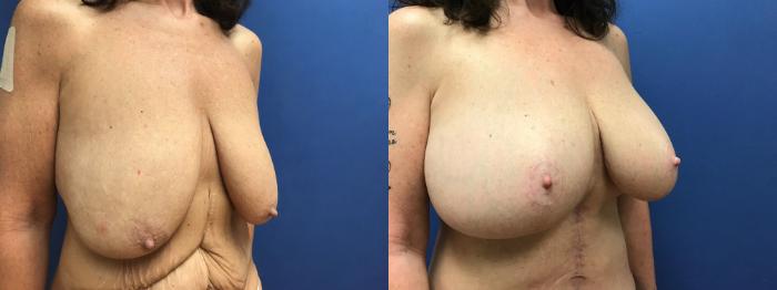 Before & After Breast Lift Case 97 Right Oblique View in Ann Arbor, MI