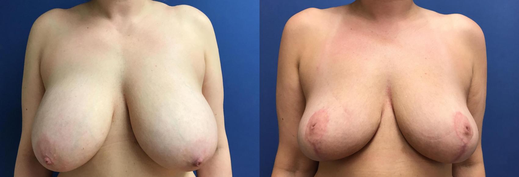 Before & After Breast Lift Case 98 Front View in Ann Arbor, MI