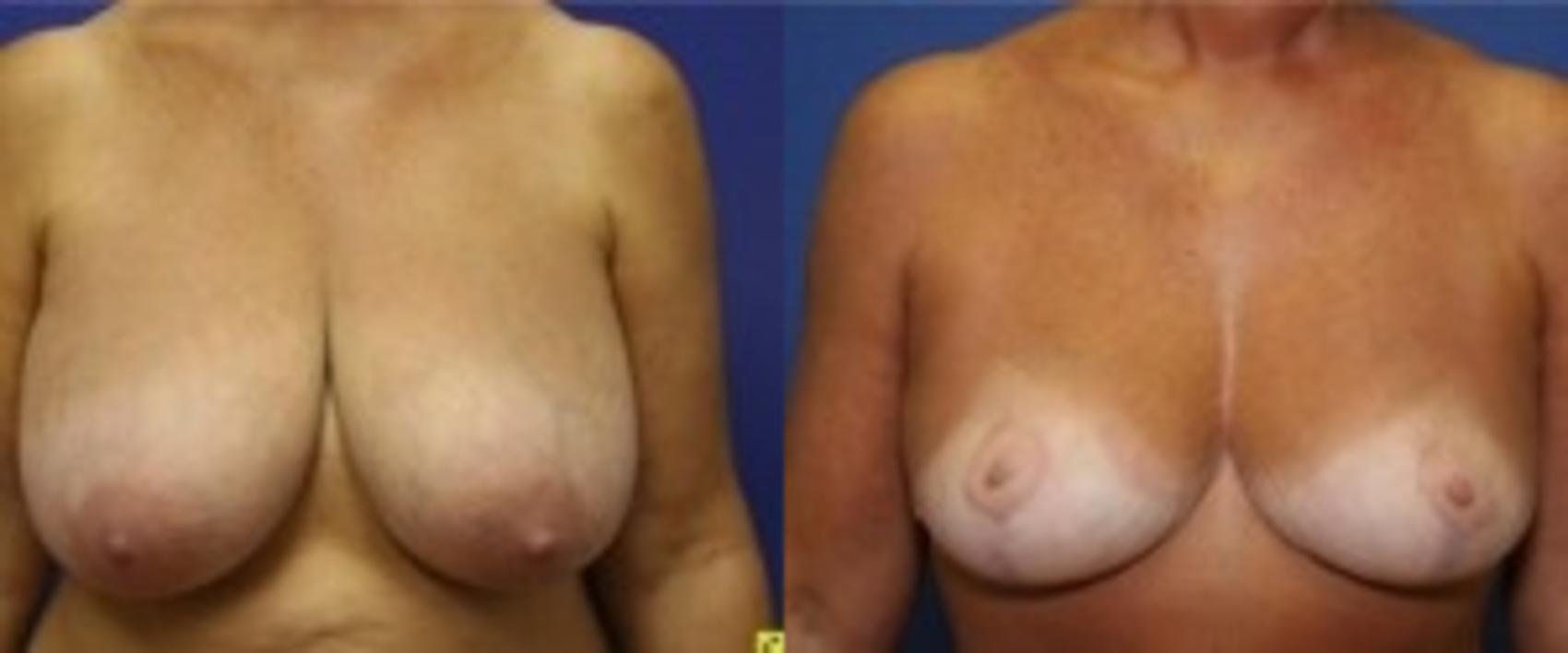 Before & After Breast Reduction Case 43 Front View in Ann Arbor, MI