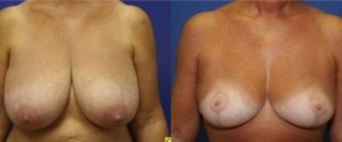 Before & After Breast Reduction Case 43 Front View in Ann Arbor, MI