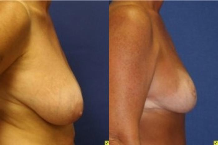 Before & After Breast Reduction Case 43 Right Side View in Ann Arbor, MI