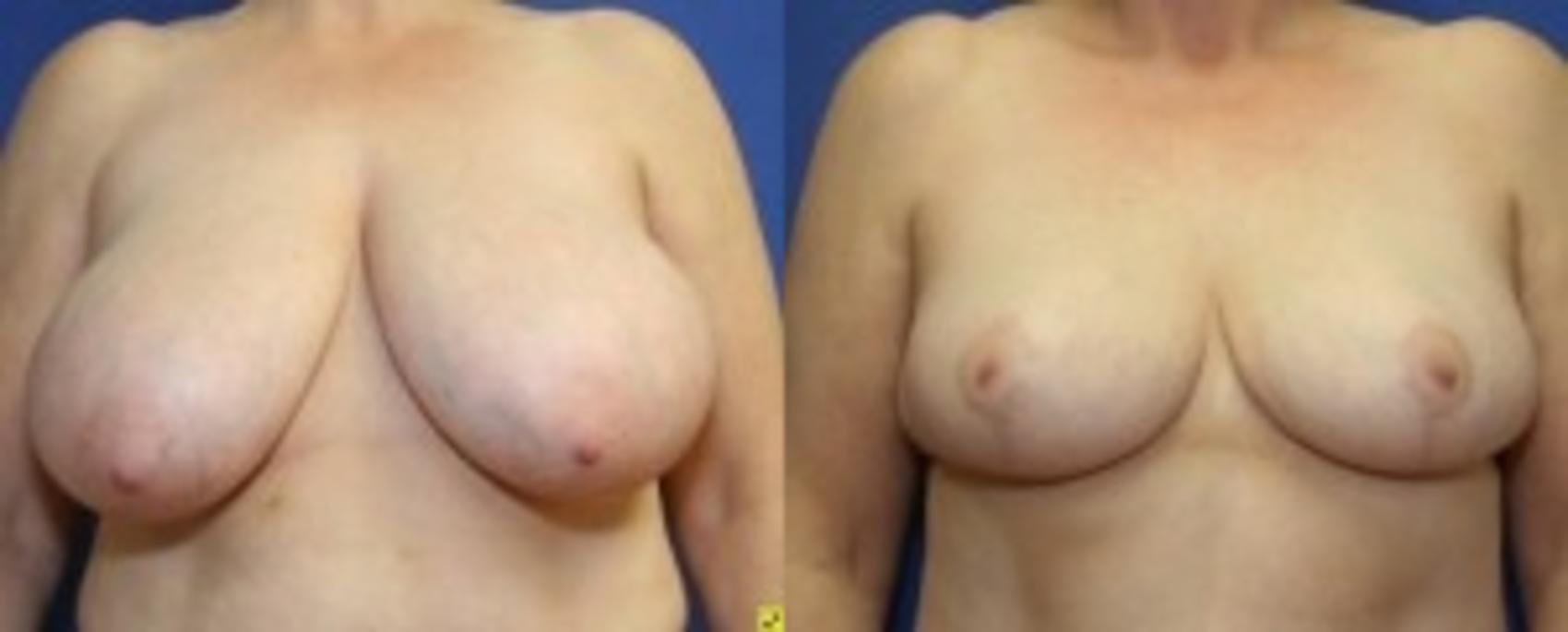 Before & After Breast Reduction Case 44 Front View in Ann Arbor, MI