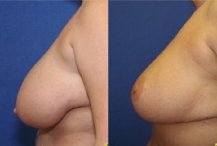 Before & After Breast Reduction Case 45 Left Side View in Ann Arbor, MI