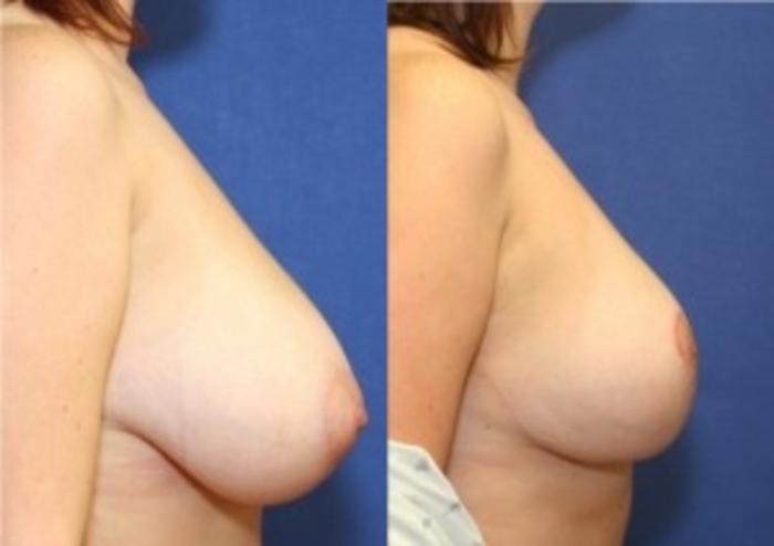 Before & After Breast Reduction Case 46 Right Side View in Ypsilanti, MI