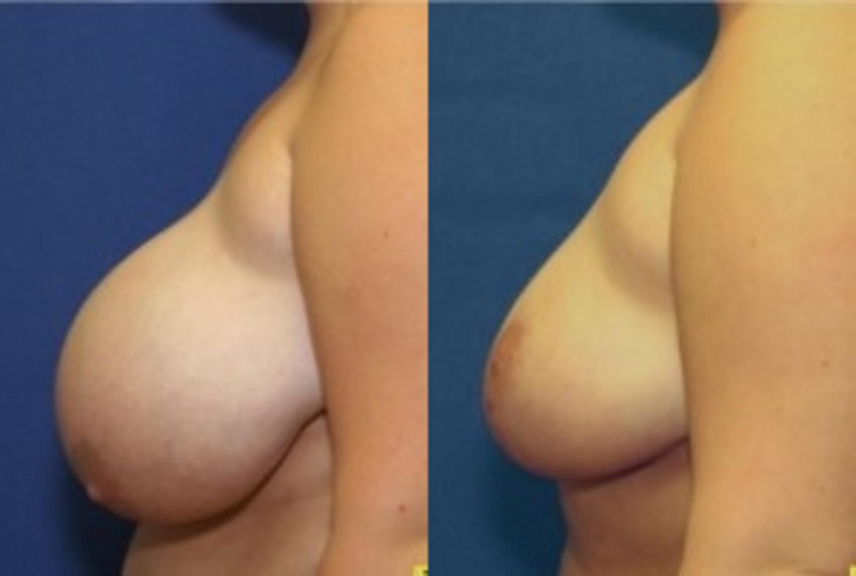 Before & After Breast Reduction Case 47 Left Side View in Ypsilanti, MI