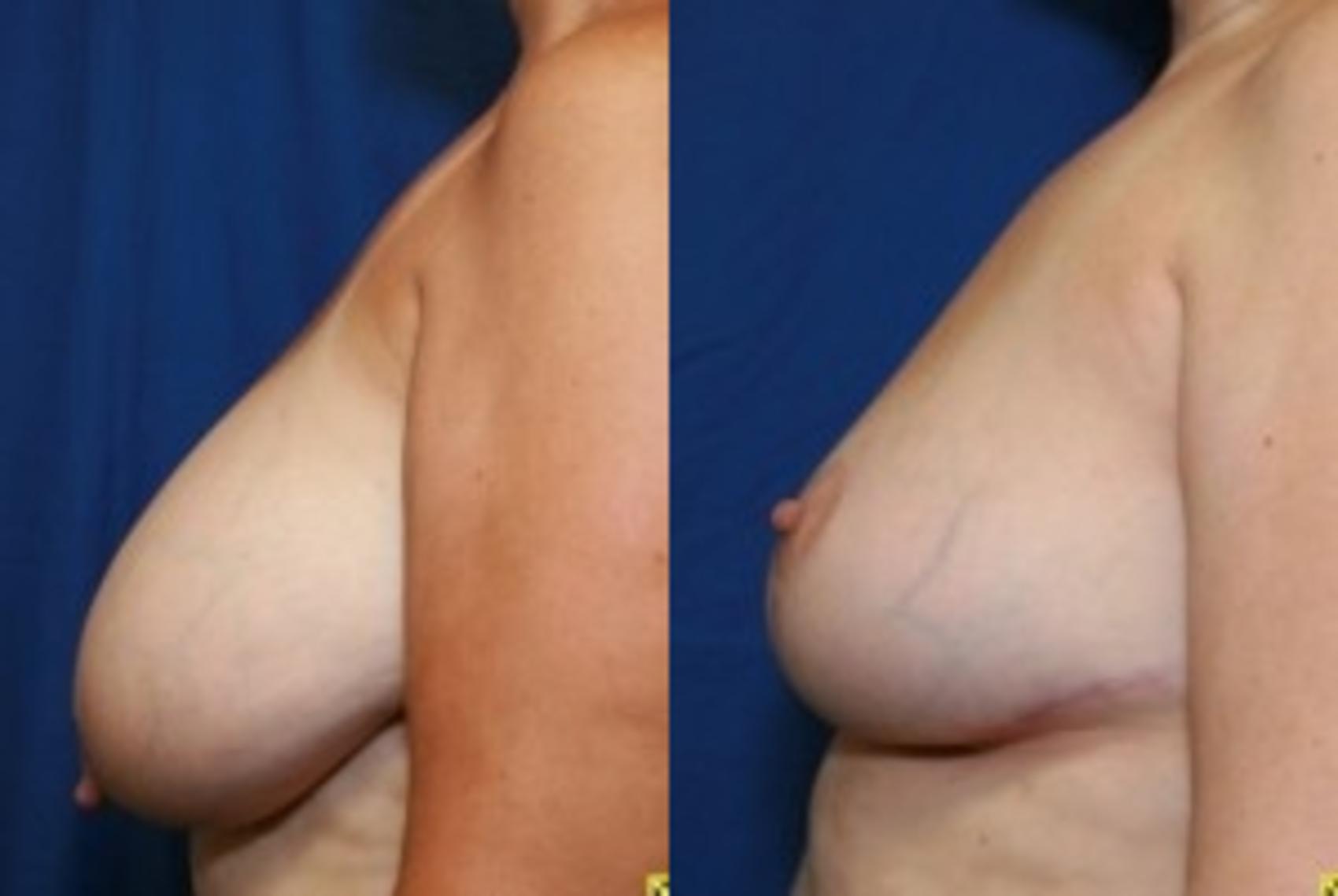 Before & After Breast Reduction Case 48 Left Side View in Ann Arbor, MI