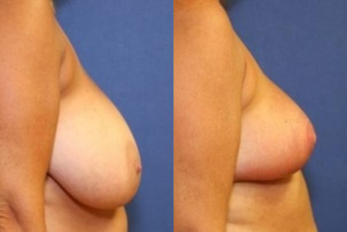 Before & After Breast Reduction Case 49 Right Side View in Ypsilanti, MI